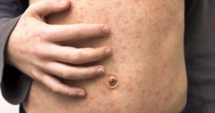 Measles likely to ‘grumble’ into summer as cases continue to surge – National