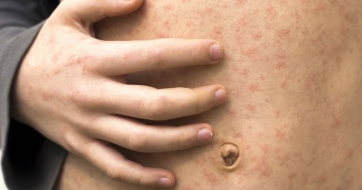 Measles surge boosts support for mandatory school vaccines: poll – National
